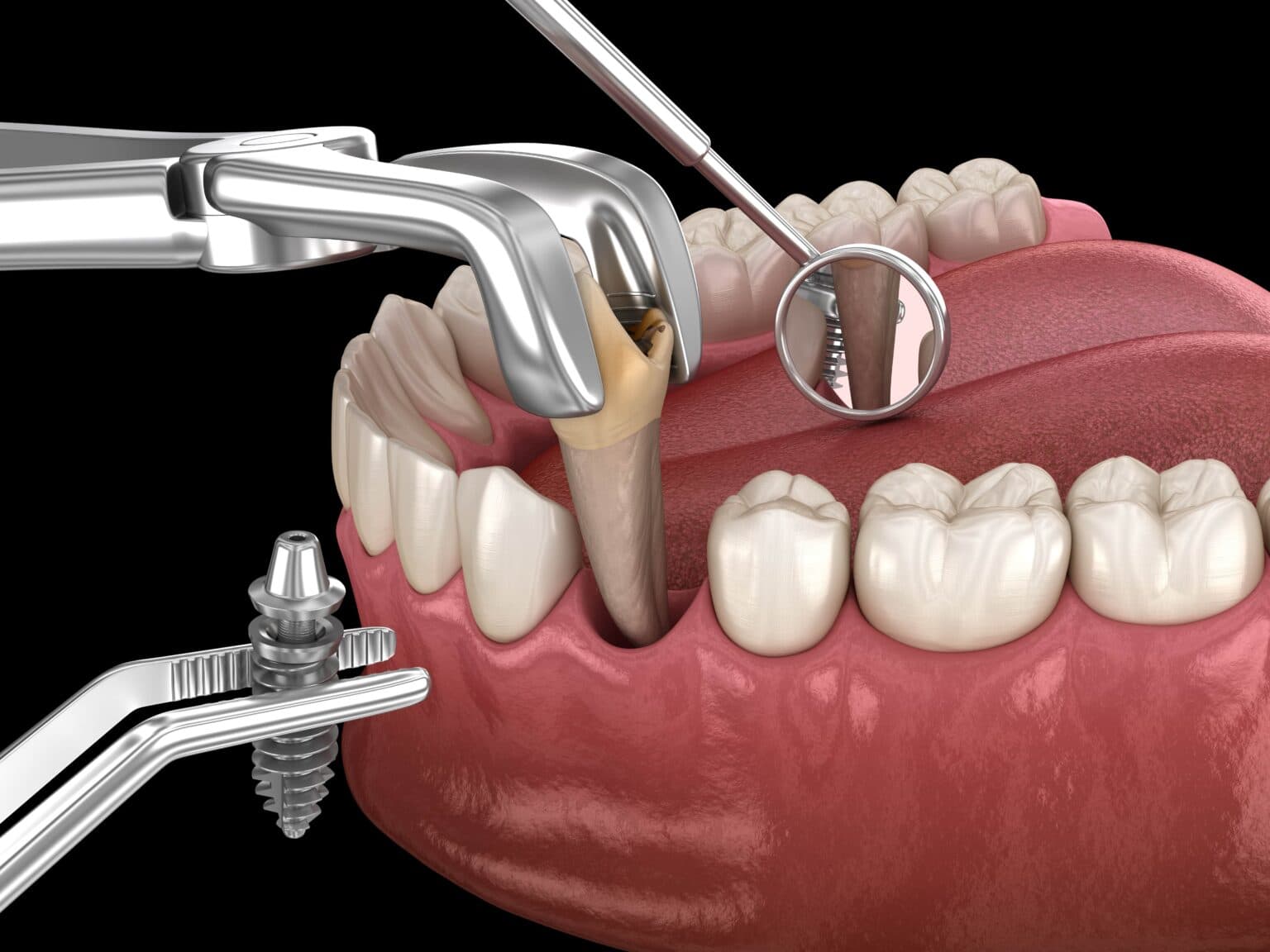 Implants & chirurgie orale
