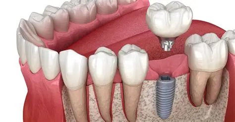 Couronne dentaire sur implant