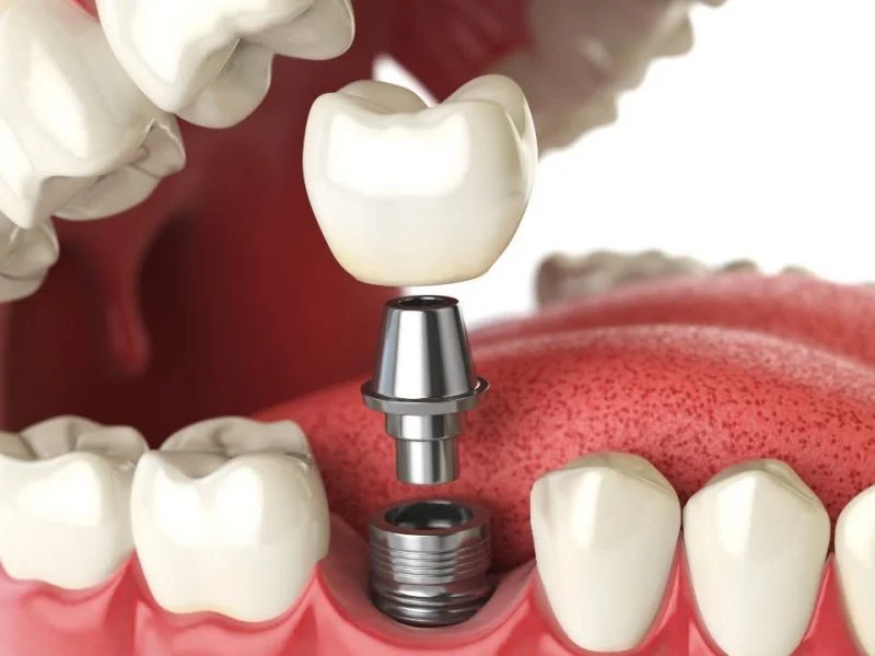 Racine artificielle de l’implant dentaire